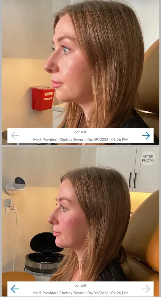 Chin Filler results at CC Aesthetics in Lexington KY