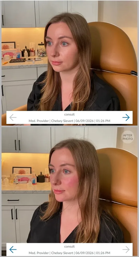Chin Filler results at CC Aesthetics in Lexington KY