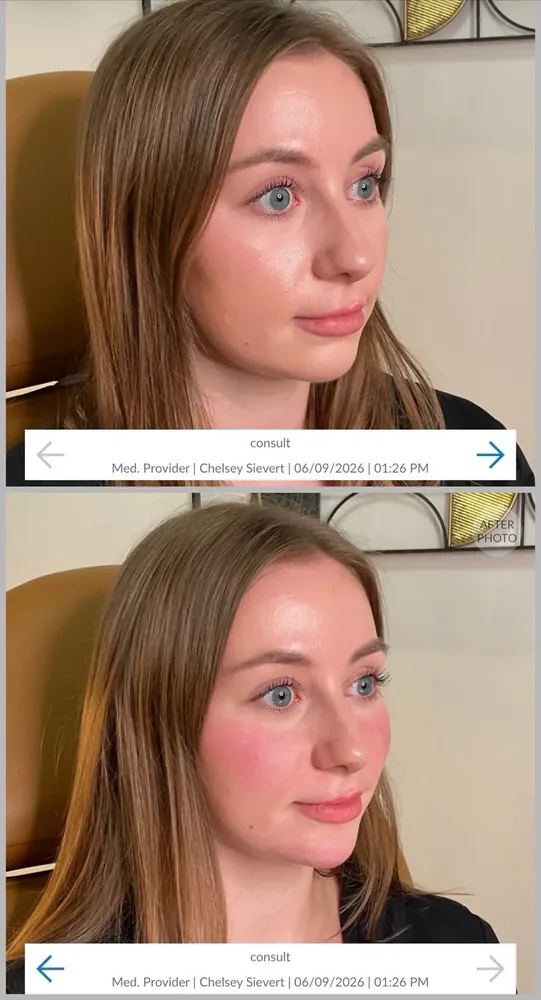 Chin Filler results at CC Aesthetics in Lexington KY