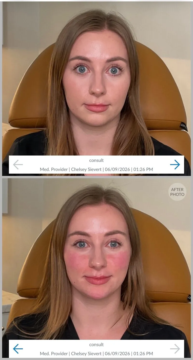 Chin Filler results at CC Aesthetics in Lexington KY