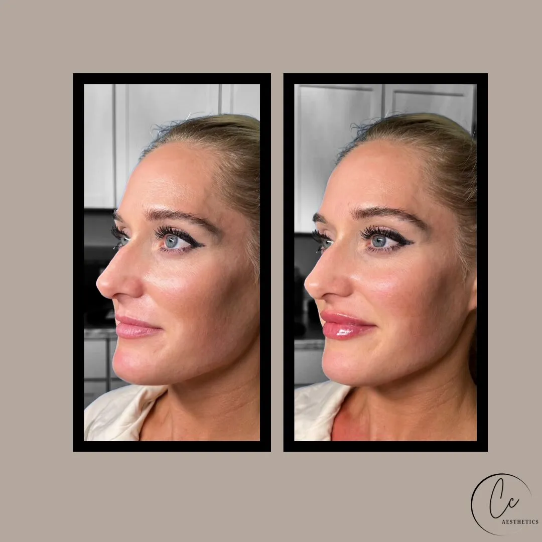 Lip Filler Results results at CC Aesthetics in Lexington KY